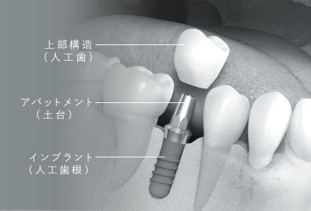 上部構造(人工歯)/アバットメント(土台)/インプラント(人工歯根)